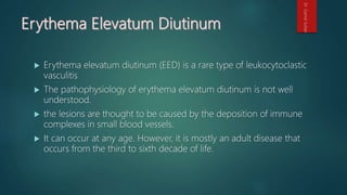  Erythema elevatum diutinum (EED) is a rare type of leukocytoclastic
vasculitis
 The pathophysiology of erythema elevatum diutinum is not well
understood.
 the lesions are thought to be caused by the deposition of immune
complexes in small blood vessels.
 It can occur at any age. However, it is mostly an adult disease that
occurs from the third to sixth decade of life.
Dr.GamalSultan
 