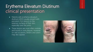  Patients with erythema elevatum
diutinum (EED) usually present with
persistent, firm lesions on the
extensor surfaces of their skin,
especially over the joints.
 These lesions are most often nodules
and round or oval plaques. However,
on rare occasions, blisters and ulcers
may also appear.
Dr.GamalSultan
 