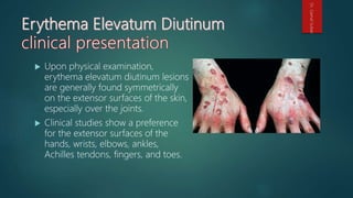 Upon physical examination,
erythema elevatum diutinum lesions
are generally found symmetrically
on the extensor surfaces of the skin,
especially over the joints.
 Clinical studies show a preference
for the extensor surfaces of the
hands, wrists, elbows, ankles,
Achilles tendons, fingers, and toes.
Dr.GamalSultan
 