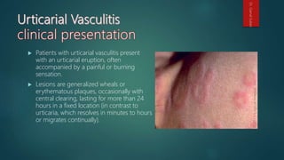  Patients with urticarial vasculitis present
with an urticarial eruption, often
accompanied by a painful or burning
sensation.
 Lesions are generalized wheals or
erythematous plaques, occasionally with
central clearing, lasting for more than 24
hours in a fixed location (in contrast to
urticaria, which resolves in minutes to hours
or migrates continually).
Dr.GamalSultan
 