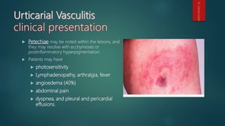 Petechiae may be noted within the lesions, and
they may resolve with ecchymoses or
postinflammatory hyperpigmentation.
 Patients may have
 photosensitivity
 Lymphadenopathy, arthralgia, fever
 angioedema (40%)
 abdominal pain
 dyspnea, and pleural and pericardial
effusions.
Dr.GamalSultan
 