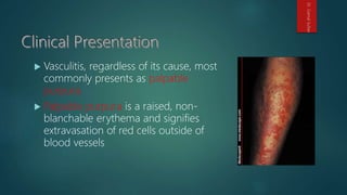  Vasculitis, regardless of its cause, most
commonly presents as palpable
purpura.
 Palpable purpura is a raised, non-
blanchable erythema and signifies
extravasation of red cells outside of
blood vessels
Dr.GamalSultan
 