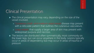  The clinical presentation may vary, depending on the size of the
vessel involved.
 Cutaneous small- and medium-sized vessel disease may present
with a reticulate pattern that outlines the cutaneous vasculature.
 Large vessels that supply a larger area of skin may present with
widespread purpura and necrosis.
 The lesions are distributed often symmetrically, most commonly on
the lower legs, but can occur anywhere in the body. Lesions typically
occur in areas of dependency but may occur in areas of trauma or
pressure
Dr.GamalSultan
 