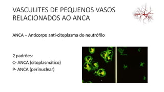 VASCULITES DE PEQUENOS VASOS
RELACIONADOS AO ANCA
ANCA – Anticorpo anti-citoplasma do neutrófilo
2 padrões:
C- ANCA (citoplasmático)
P- ANCA (perinuclear)
 