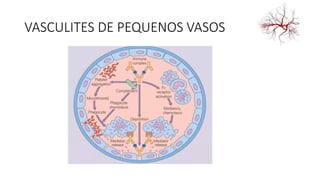 VASCULITES DE PEQUENOS VASOS
 