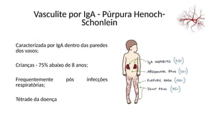 Vasculite por IgA - Púrpura Henoch-
Schonlein
Caracterizada por IgA dentro das paredes
dos vasos;
Crianças - 75% abaixo de 8 anos;
Frequentemente pós infecções
respiratórias;
Tétrade da doença
 