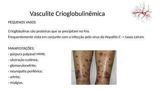 Vasculite Crioglobulinêmica
PEQUENOS VASOS
Crioglobulinas são proteínas que se precipitam no frio.
Frequentemente vista em conjunto com a infecção pelo vírus da Hepatite C -> taxas caíram
MANIFESTAÇÕES:
- púrpura palpável MMII;
- ulceração cutânea;
- glomerulonefrite;
- neuropatia periférica;
- artrite;
- mialgias.
 