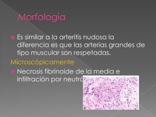  Es similar a la arteritis nudosa la
  diferencia es que las arterias grandes de
  tipo muscular son respetadas.
Microscópicamente
 Necrosis fibrinoide de la media e
  infiltración por neutrófilos
 