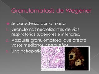   Se caracteriza por la Triada
1. Granulomas necrotizantes de vías
   respiratorias superiores e inferiores.
2. Vasculitis granulomatosa que afecta
   vasos medianos y pequeños.
3. Una nefropatía
 