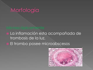 Microscópicamente
 La inflamación esta acompañada de
  trombosis de la luz.
 El trombo posee microabscesos
 