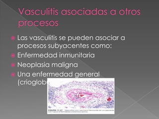  Las vasculitis se pueden asociar a
  procesos subyacentes como:
 Enfermedad inmunitaria
 Neoplasia maligna
 Una enfermedad general
  (crioglobulinemia mixta)
 