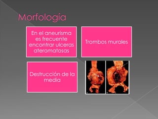 En el aneurisma
  es frecuente
                    Trombos murales
encontrar ulceras
  ateromatosas



Destrucción de la
     media
 