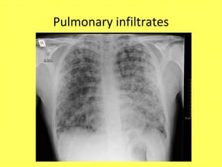Pulmonary infiltrates
 