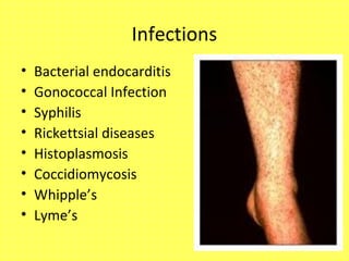 Infections
• Bacterial endocarditis
• Gonococcal Infection
• Syphilis
• Rickettsial diseases
• Histoplasmosis
• Coccidiomycosis
• Whipple’s
• Lyme’s
 