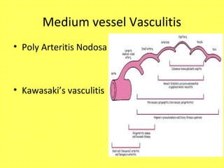 Medium vessel Vasculitis
• Poly Arteritis Nodosa
• Kawasaki’s vasculitis
 