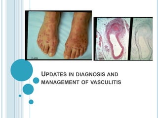 UPDATES IN DIAGNOSIS AND
MANAGEMENT OF VASCULITIS
 