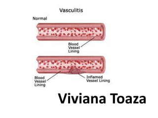 vasculitis
Viviana Toaza
 