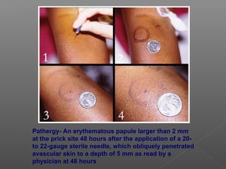 Pathergy- An erythematous papule larger than 2 mm
at the prick site 48 hours after the application of a 20-
to 22-gauge sterile needle, which obliquely penetrated
avascular skin to a depth of 5 mm as read by a
physician at 48 hours
 