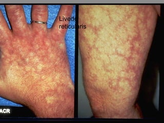 Livedo
reticularis
 
