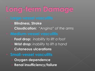 • Large-vessel vasculitis
– Blindness, Stroke
– Claudication: “Angina” of the arms
• Medium-vessel vasculitis
– Foot drop: inability to lift a foot
– Wrist drop: inability to lift a hand
– Cutaneous ulcerations
• Small-vessel vasculitis
– Oxygen dependence
– Renal insufficiency/failure
 