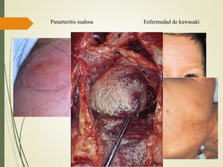 Panarteritis nudosa Enfermedad de kawasaki
 