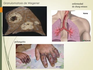 Granulomatosis de Wegener
17
enfermedad
de churg-strauss
poliangeítis
 