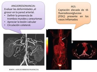 ANGIORESONANCIA:
Evaluar las deformidades ,el
grosor en la pared arterial.
• Definir la presencia de
trombos murales y aneurismas
• Apreciar la lesión valvular
• Circulación colateral.
PET:
Captación elevada de 18-
fluorodesoxiglucosa
(FDG) presente en los
vasos inflamados
 
