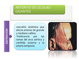 ARTERITIS DE CELULAS
GIGANTES
DEFINICION
vasculitis sistémica que
afecta arterias de grande
y mediano calibre.
Preferencia por las
ramas del arco aórtico y
carótida externa y la
arteria temporal.
 