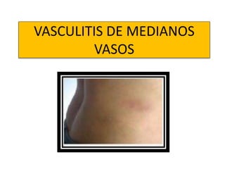 VASCULITIS DE MEDIANOS
VASOS
 