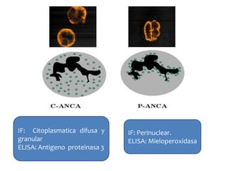 IF: Citoplasmatica difusa y
granular
ELISA: Antigeno proteinasa 3
IF: Perinuclear.
ELISA: Mieloperoxidasa
 
