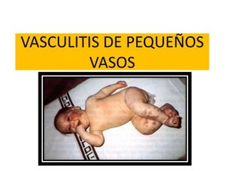 VASCULITIS DE PEQUEÑOS
VASOS
 