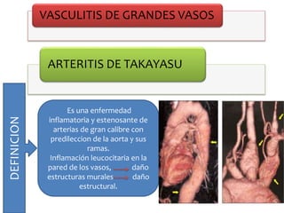 VASCULITIS DE GRANDES VASOS
ARTERITIS DE TAKAYASU
DEFINICION
Es una enfermedad
inflamatoria y estenosante de
arterias de gran calibre con
predileccion de la aorta y sus
ramas.
Inflamación leucocitaria en la
pared de los vasos, daño
estructuras murales daño
estructural.
 