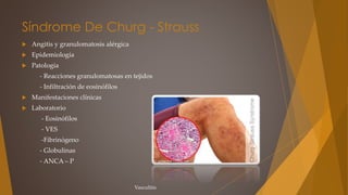 Síndrome De Churg - Strauss
 Angitis y granulomatosis alérgica
 Epidemiología
 Patología
- Reacciones granulomatosas en tejidos
- Infiltración de eosinófilos
 Manifestaciones clínicas
 Laboratorio
- Eosinófilos
- VES
-Fibrinógeno
- Globulinas
- ANCA – P
Vasculitis
 