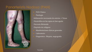 Panarteristis Nodosa (PAN)
 PAN Clásica
 Patología
-Inflamación necrosante de arterias -> Venas
-Neutrófilos en las capas en fase aguda
-Necrosis fibrinoide
-Depósito de colágeno
 Manifestaciones clínicas generales
 Laboratorio
 Diagnóstico : Biopsia, angiografía
Vasculitis
 