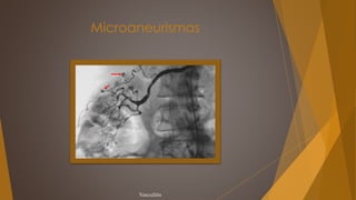 Microaneurismas
Vasculitis
 