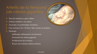 Arteritis de la Temporal
(de células gigantes)
 Vaso de mediano y gran calibre
 Arteria carótida y sus ramas
 Asociada a la polimialgia reumática.
 Casi exclusivo de > 50 años. Más común en mujeres.
 Patología
Infiltrados inflamatorio de linfocitos
Formación de células gigantes
Proliferación de la íntima
Rotura de la lámina elástica interna.
Vasculitis
 