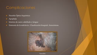 Complicaciones
 Neuritis Óptica Isquémica
 Apoplejía
 Infartos de cuero cabelludo y lengua
 Estenosis de la subclavia : Claudicación braquial. Aneurismas.
Vasculitis
 