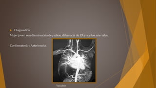  Diagnóstico
Mujer joven con disminución de pulsos, diferencia de PA y soplos arteriales.
Confirmatorio : Arteriorafía.
Vasculitis
 