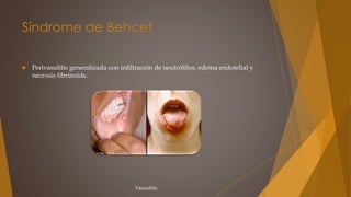 Síndrome de Behcet
 Perivasulitis generalizada con infiltración de neutrófilos, edema endotelial y
necrosis fibrinoide.
Vasculitis
 