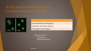 Anticuerpos Antineutrófilos
Citoplasmáticos (ANCA)
Granulomatosis de Wegener
Síndrome de Churg- Strauss
Poliangitis microscópica
Tipos de ANCA
- Proteinasa 3
- Mieloperoxidasa
Vasculitis
 
