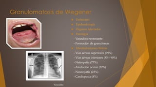 Granulomatosis de Wegener
 Definición
 Epidemiología
 Órganos Afectados
 Patología
- Vasculitis necrosante
- Formación de granulomas
 Manifestaciones clínicas
- Vías aéreas superiores (95%)
- Vías aéreas inferiores (85 – 90%)
- Nefropatía (77%)
- Afectación ocular (52%)
- Neuropatía (23%)
- Cardiopatía (8%)
Vasculitis
 