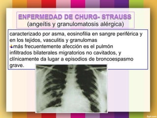 caracterizado por asma, eosinofilia en sangre periférica y
en los tejidos, vasculitis y granulomas
más frecuentemente afección es el pulmón
infiltrados bilaterales migratorios no cavitados, y
clínicamente da lugar a episodios de broncoespasmo
grave.
 