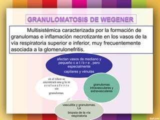 Multisistémica caracterizada por la formación de
granulomas e inflamación necrotizante en los vasos de la
vía respiratoria superior e inferior, muy frecuentemente
asociada a la glomerulonefritis.
afectan vasos de mediano y
pequeño c a l i b r e , pero
especialmente
capilares y vénulas
granulomas
intravasculares y
extravasculares
vasculitis y granulomas.
La
biopsia de la vía
respiratoria
en el riñon se
encontrará una g lo m
e r u l o n e f r i t i s
sin
granulomas.
 