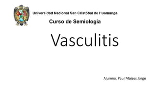 Vasculitis
Alumno: Paul Moises Jorge
Universidad Nacional San Cristóbal de Huamanga
Curso de Semiología
 