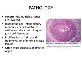 PATHOLOGY
• Panarteritis, multiple arteries
are involved
• Histopathology: inflammatory
mononuclear cell infiltrates
within vessel wall with frequent
giant cell formation
• Proliferation of intima and
fragmentation of internal elastic
lamina
• Often cause ischemia of affected
organs.
 