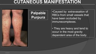 CUTANEOUS MANIFESTATION
6/3/2018
Palpable
Purpura
•Caused by extravasation of
RBCs from small vessels that
have been occluded by
immunecomplexes.
• They are heavy and tend to
occur in the most gravity
dependent area of the body
 