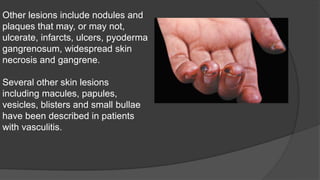 Other lesions include nodules and
plaques that may, or may not,
ulcerate, infarcts, ulcers, pyoderma
gangrenosum, widespread skin
necrosis and gangrene.
Several other skin lesions
including macules, papules,
vesicles, blisters and small bullae
have been described in patients
with vasculitis.
 