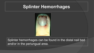 Splinter Hemorrhages
Splinter hemorrhages can be found in the distal nail bed
and/or in the periungual area.
 