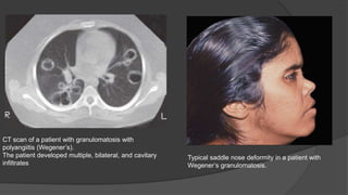 CT scan of a patient with granulomatosis with
polyangiitis (Wegener’s).
The patient developed multiple, bilateral, and cavitary
infiltrates
Typical saddle nose deformity in a patient with
Wegener’s granulomatosis.
 