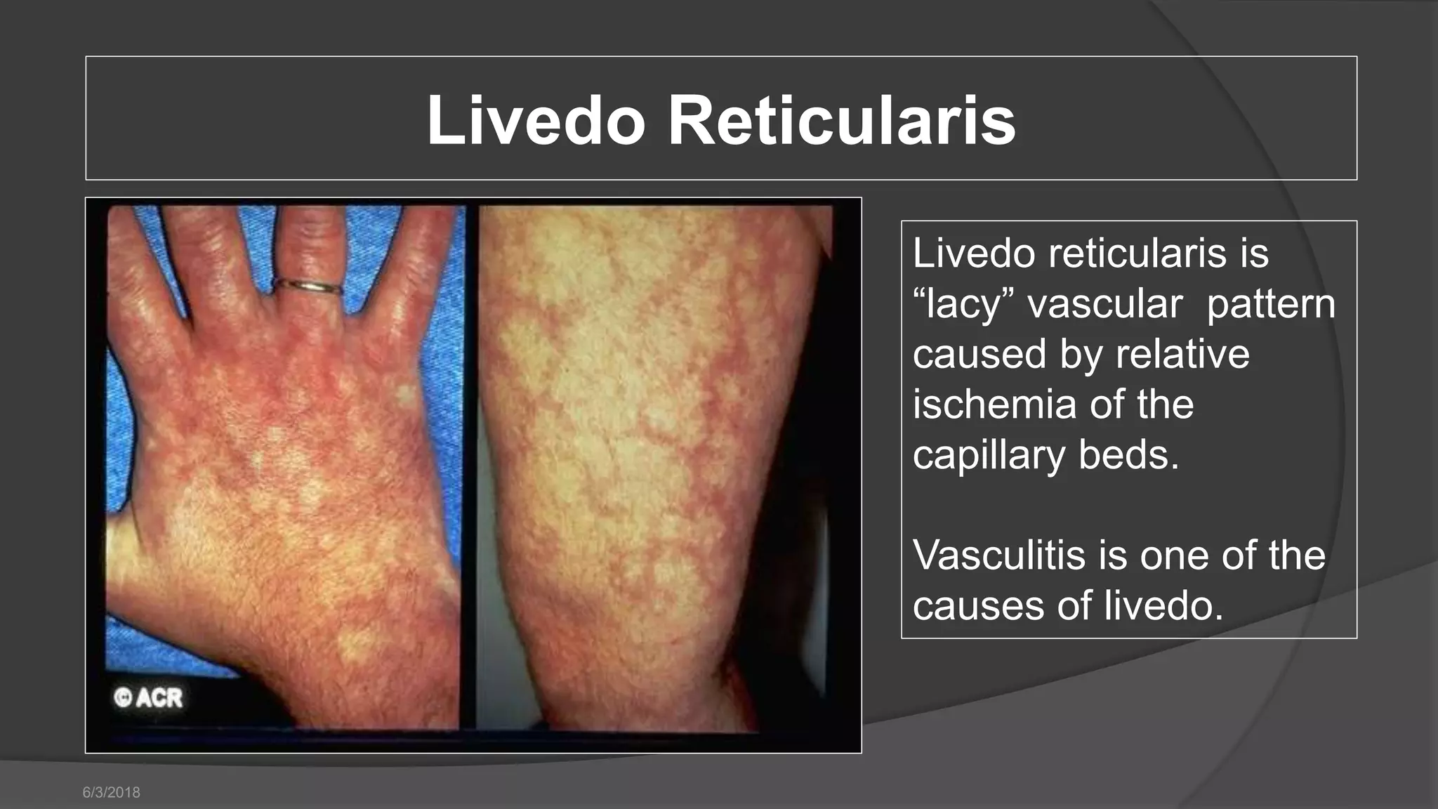 THE VASCULITIS SYNDROME | PPTX